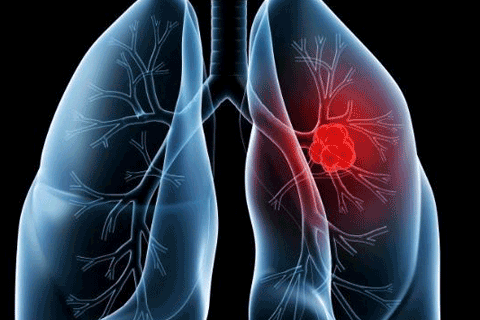 pulmonary-image-holder