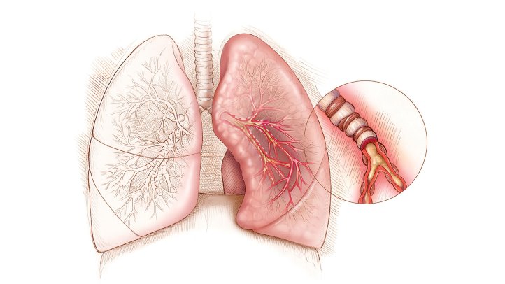lungs with severe asthma - what to do if it gets out of control