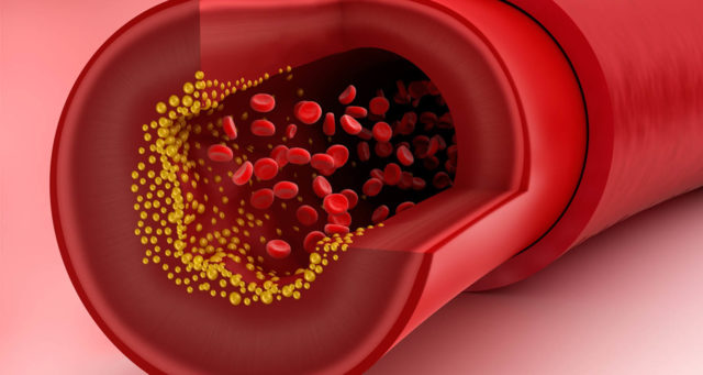 across the an artery - everything-you-need-to-know-about-cholesterol