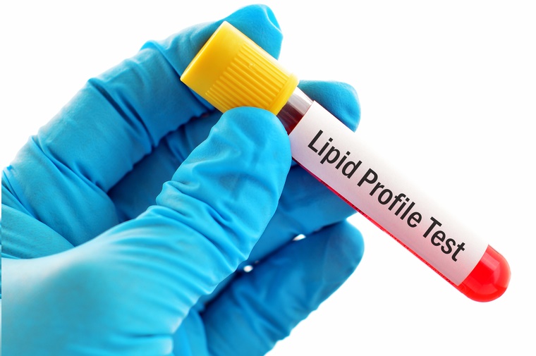 lipid profile test - interpret your cholesterol level numbers